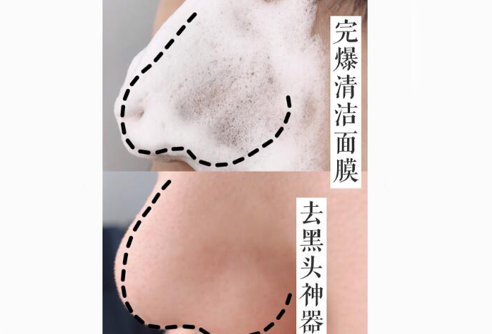 去黑头最有效的产品？去除黑头小妙招？