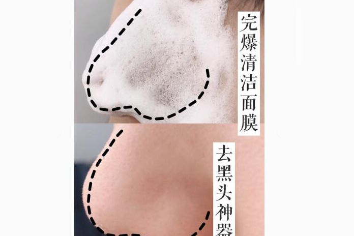 去黑头最有效的产品？去除黑头小妙招？-3