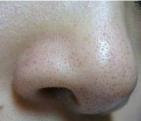 苏诗雅毛孔清洁仪有用吗? 苏诗雅毛孔清洁仪有用吗?