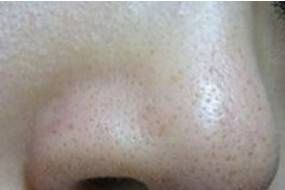 苏诗雅毛孔清洁仪有用吗？-1