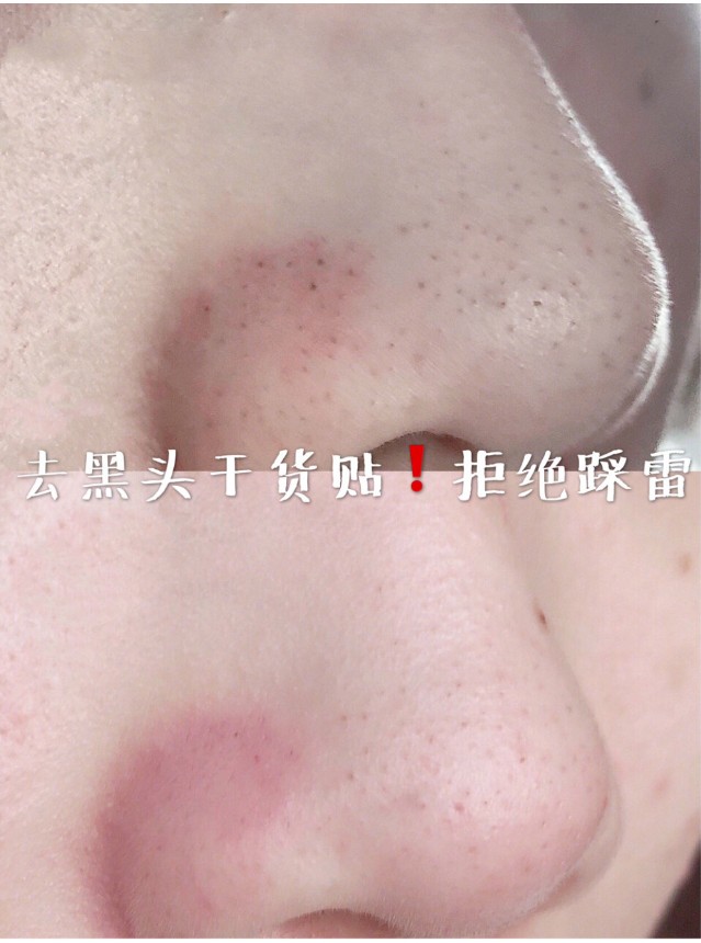 干货！苏诗雅黑头仪一周完美去黑头，解决草莓鼻！