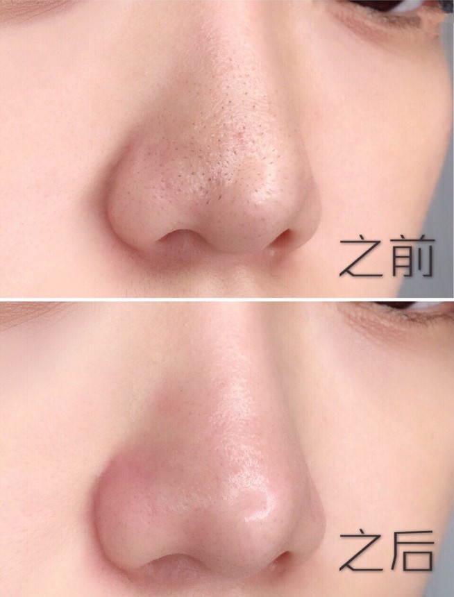 干货！苏诗雅黑头仪一周完美去黑头，解决草莓鼻！