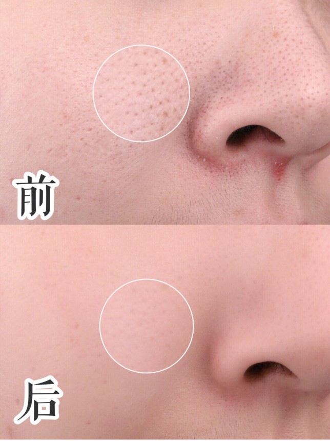 黑头克星---- 苏诗雅黑头仪