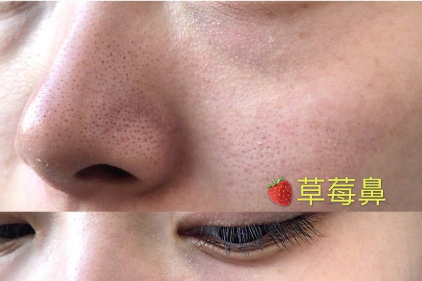 抗黑头经验分享，七年黑头终于拔除，用苏诗雅黑头仪，告别草莓鼻-3