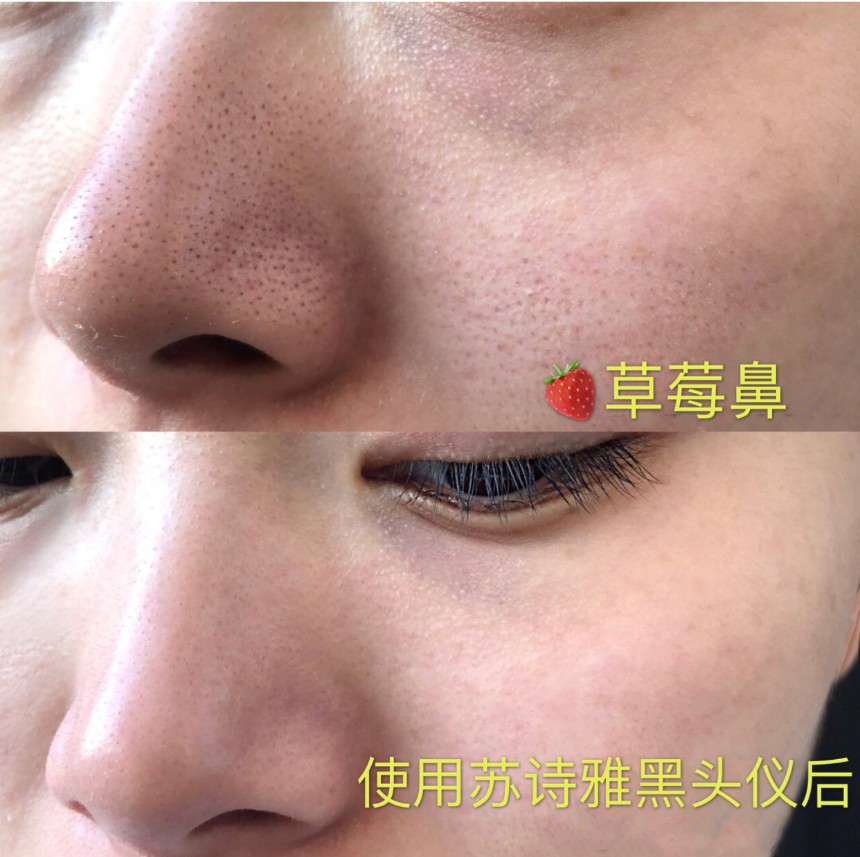 星星点点的“草莓鼻”非常影响颜值，苏诗雅黑头仪轻松去黑头