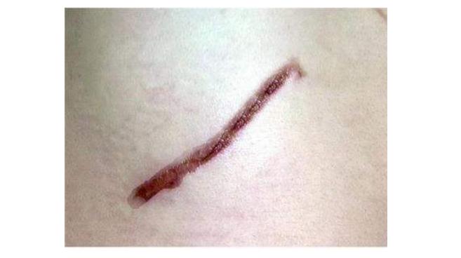 什么时候用除疤膏效果最好 好用除疤膏推荐 什么时候用除疤膏效果最好 好用除疤膏推荐