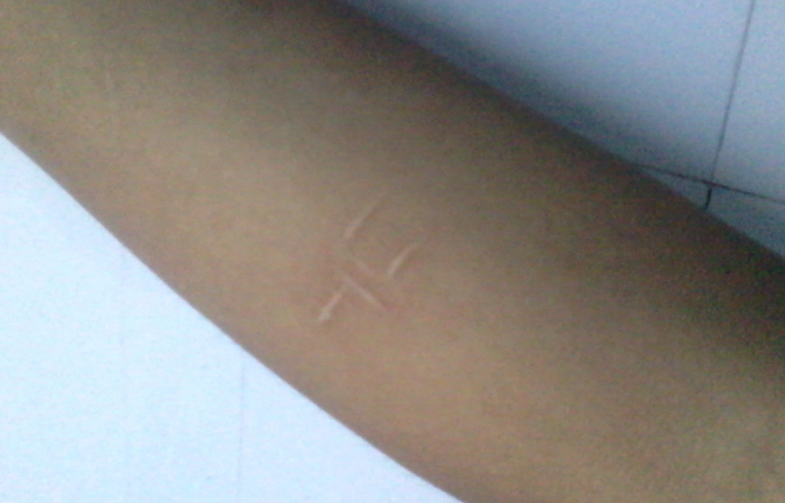 什么时候用除疤膏效果最好 好用除疤膏推荐 什么时候用除疤膏效果最好 好用除疤膏推荐