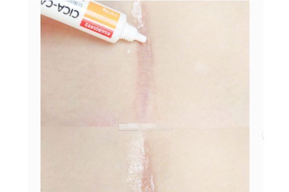 仙卡祛疤贴真的好用吗？多长时间可以有效果？-1