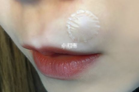 护妍天使隐形净痘贴有效果吗？使用感受怎么样？-1