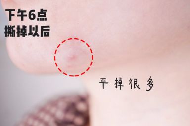 护妍天使痘痘贴好用吗？主要成分是什么呢？-1