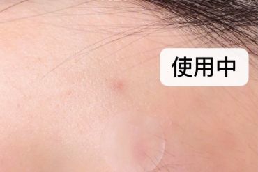 vt痘痘贴成分？可以使痘痘消肿吗？-1