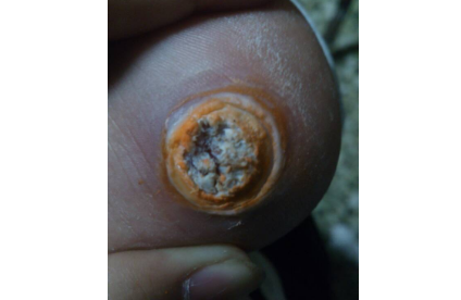 鸡眼贴怎么用正确？鸡眼贴到什么程度算好?