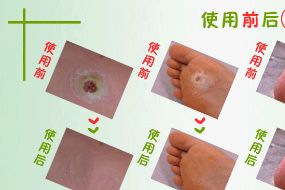 鸡眼贴怎么用正确？鸡眼贴到什么程度算好?-2
